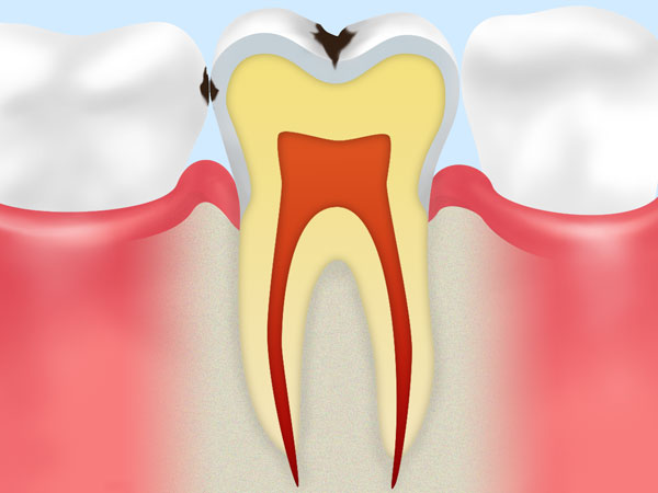 [C1]エナメル質の虫歯
